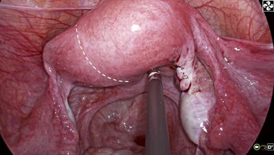 Laparo-Endoscopic Single Site Combined With Hysteroscopy to Diagnose and Treat Robert’s Uterine Malformation: A Case Report